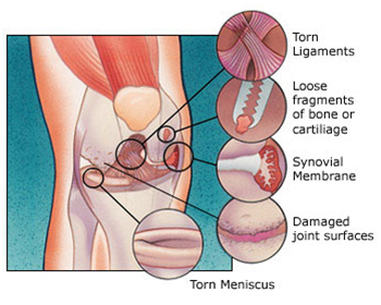 Arthroscopic Procedure, Minimally Invasive Surgical Procedure, Arthroscopy Surgery India