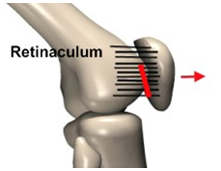 Arthroscopic Lateral Retinacular Release, Arthroscopic, India Hospital Tour