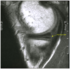 Arthroscopic Meniscectomy Surgery, Arthroscopic Meniscectomy Surgery India