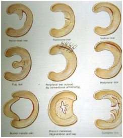 Arthroscopic Meniscectomy Surgery India, Arthroscopic Meniscectomy Surgery Abroad