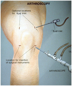 Arthroscopic Meniscectomy Surgery India, Arthroscopic