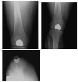 Patello Femoral, India, Patello Femoral Replacement, Patello Femoral Replacement Surgery India