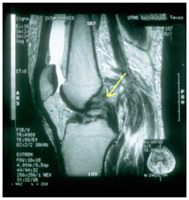 Pcl, Reconstruction Surgery, Pcl Reconstruction, Pcl Reconstruction Surgery India