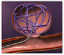 Endovascular Coiling Surgery India, Aneurysm Treatment India, Endovascular Coil India