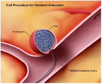 Endovascular Coiling Surgery India, Endovascular Coil India, India Hospital Tour India