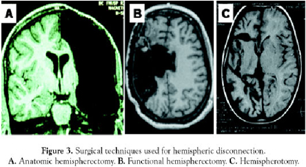 Hemispherectomy India Offers info on Hemispherectomy Surgery India, Hemispherectomy India, Hemispherectomy Surgery India