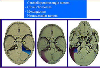 Skull Base Surgery India Offers info on Skull Base India, Skull Base Surgery India, Brain Rests India