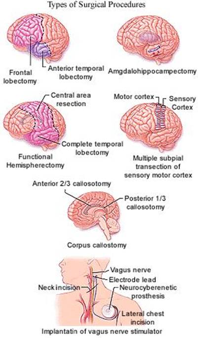 Epilepsy Treatment India Offers info on Epilepsy India, Epileptic Seizures 