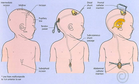 Shunt Surgery India, Shunt India Offers info on Shunt Surgery India, Shunt Surgery Information India, Tube Shunt Surgery India