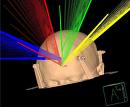 Trigeminal Neuralgia Stereotactic India, Radiosurgery India, Stereotactic Radiosurgery Information India