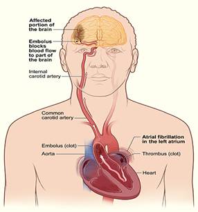 Stroke Treatment India, Stroke India Offers info on Stroke Treatment India, Stroke Rehabilitation India