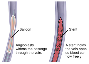 Venous Angioplasty Surgery Low Cost In India, Venous Angioplasty Surgery, Venous Angioplasty Surgery Mumbai India, Venous Angioplasty Surgery India, Venous Angioplasty Surgery Hyderabad India, Angioplasty, S Venous Angioplasty Surgery symptoms, Venous Angioplasty Surgery Related Symptoms, Venous Angioplasty Surgery Kolkata India, Signs, Signs And Symptoms