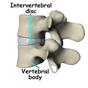 Artificial Lumbar Disc Replacement, Artificial Disc, Disc Replacement