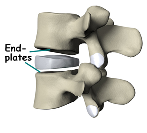 Artificial Disc Replacement India, Artificial Disc