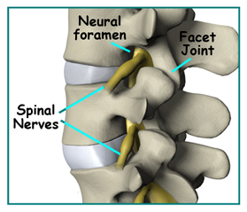 Artificial Lumbar Disc Replacement, Disc Replacement, Artificial Disk