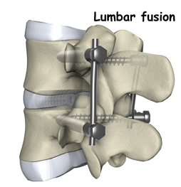 Artificial Lumbar Disc Replacementa, Artificial Disc, Artificial Disk, India Hospital Tour