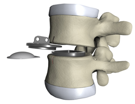 Artificial Disc, Disc Replacement, Artificial Disk, Spine, India Hospital Tour