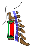 Anterior Cervical Corpectomy, Discectomy, Corpectomy Anterior Cervical Corpectomy Spine India