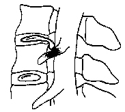 Cervical, Surgery, Pain, Tingling, Graft