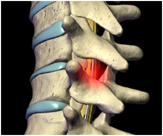 Degenerative Disc Disease, Degenerative Disc Disease Surgery