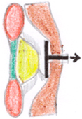 Endoscopic Microdiscectomy, India Micro Disectomy, Endoscopic