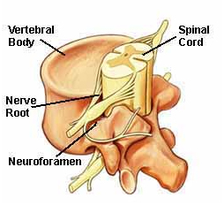 Foraminotomy Surgery, Foraminotomy India, Neuroforamen