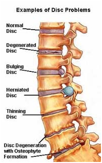 Foraminotomy Surgery, Foraminotomy India, Neuroforamen,L4 Foraminotomy, Treatment Option