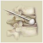 Kyphosis, Curves, Anterior, Posterior, Surgery For Kyphosis, Kyphosis Picture, Kyphosis Cause