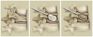 Kyphosis Surgery, Curves, Posterior, Surgery For Kyphosis, Kyphosis Cause, Kyphosis Symptom