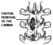 , Lumbar, Laminectomy, Lumbar Laminectomy Surgical Procedure