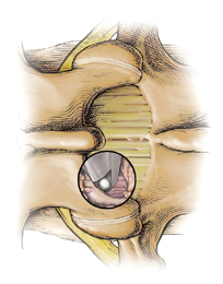 Minimally Invasive Laminotomy India, Laminotomy India, Medications India, Minimally Invasive Discectomy India