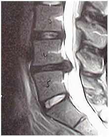 Microlumbar Discectomy, Discectomy Surgery, Microlumbar Discectomy, Outpatient Procedure