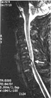 Myelopathy, Myelopathy Surgery, Myelopathy India, Cervical Spondylotic Myelopathy, Spinal Canal Stenos