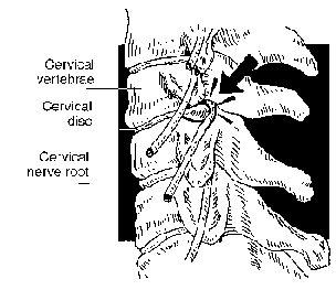 Percutaneous Endoscopic Lumbar Discectomy, Endoscopic, Percutaneous Endoscopic