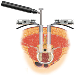 Surgery, Interbody Fusion Surgery, Lumbar, Posterior Lumbar