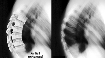 Sherman's Disease, Scheuermann's Kyphosis, Osteochondrosis, Juvenile Disc Disorder