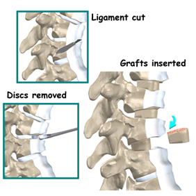 Scheuermann's Disease, Sherman's Disease, Osteochondrosis, Juvenile Disc Disorder, Lumbar Scheuermann's