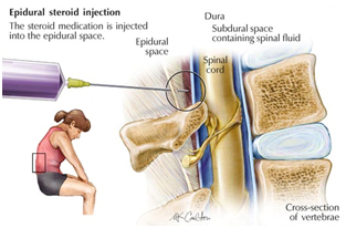 Sciatica Surgery, Spine, Surgery, Microdiscectomy, Laminotomy, Severe Leg Pain, India Hospital Tour