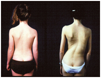 Scoliosis Treatment, Scoliosis Surgery India