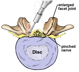 Decompressive, Decompressive Laminectomy For, Spinal Stenosis,  Decompressive For