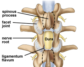 Decompressive Laminectomy, Decompressive, , Spinal Stenosis,  Decompressive For