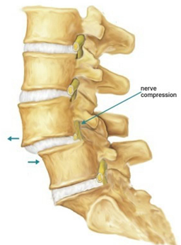 Spondylolisthesis Surgery, Spondylolisthesis, Spondylolisthesis Correction