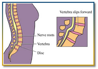 Spondylolisthesis Correction, Spondylolisthesis Diagnosis, Spondy, Lower Back Pain