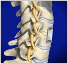 Anterior Cervical Discectomy, Anterior Cervical Discectomy India