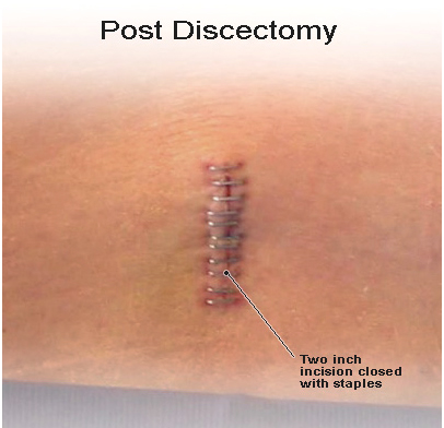 Slipped Disc, Slipped disc surgery India, Slipped disc Treatment India, Slipped, Disc, Spinal Cord