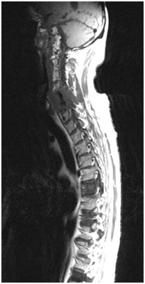 Spinal Metastasis, Metastatic Disease, Spinal Metastasis India, Spinal