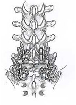 Spinal Fusion Decompression, Spinal Fusion, Spinal Disc Decompression, Spinal Disk Decompression