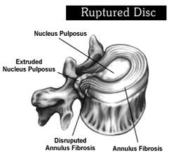 Spine Treatment India, India General Spinal Anatomy, Cervical, The Thoracic, Spinous Process