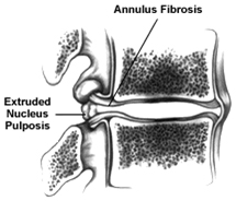 Spine Treatment India, Cervical