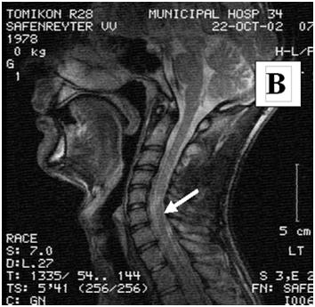 Stem Cell Spine Therapy, India Stem Cell Treatments